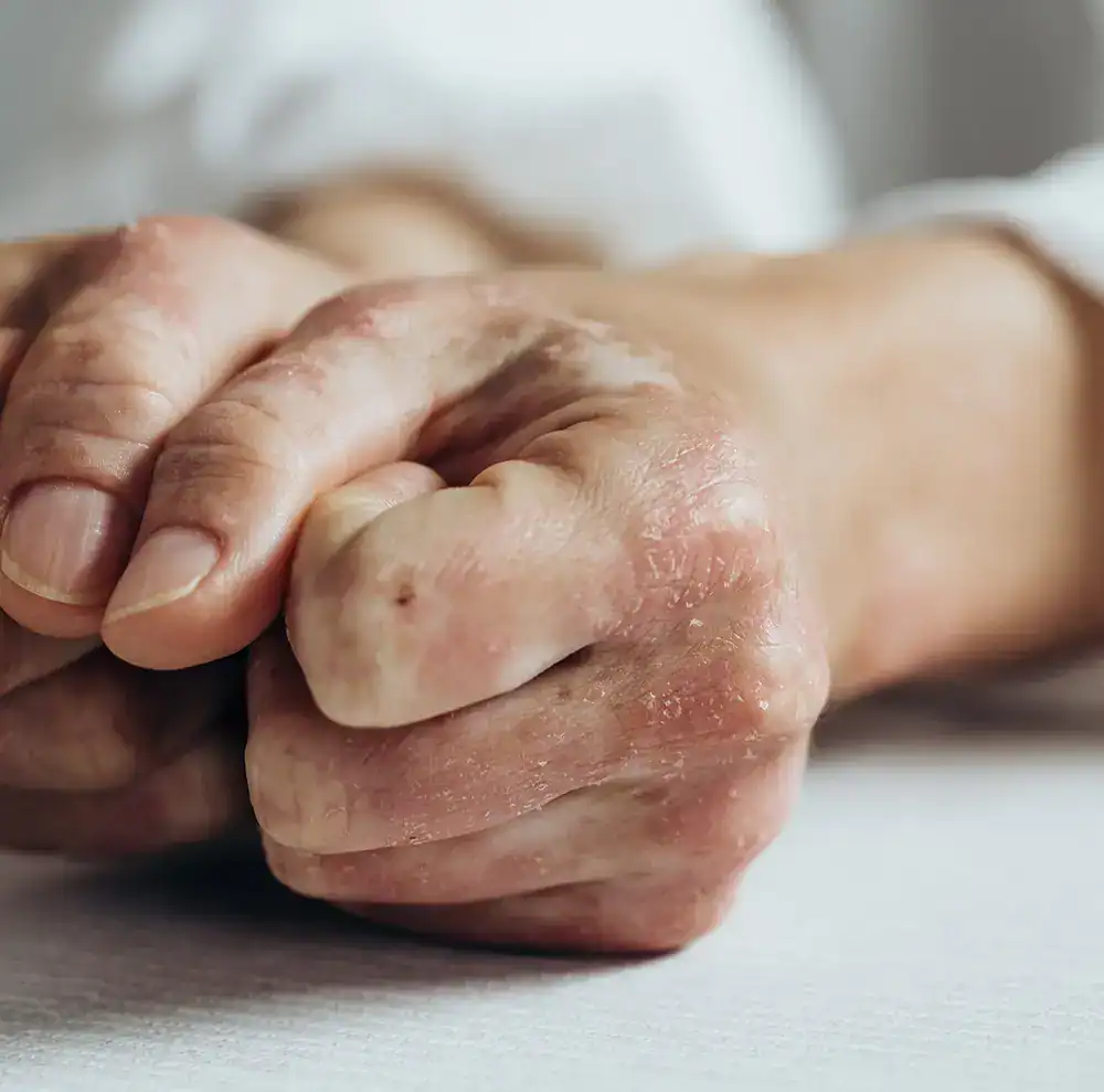 Psoriasis Schuppenflechte an den Händen