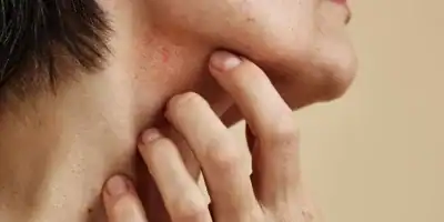 Bild Psoriasis und Ayurveda